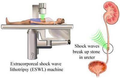 Kidney Stone Treatment in Hadapsar