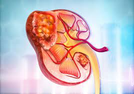 Kidney Stone Treatment in Kondhwa