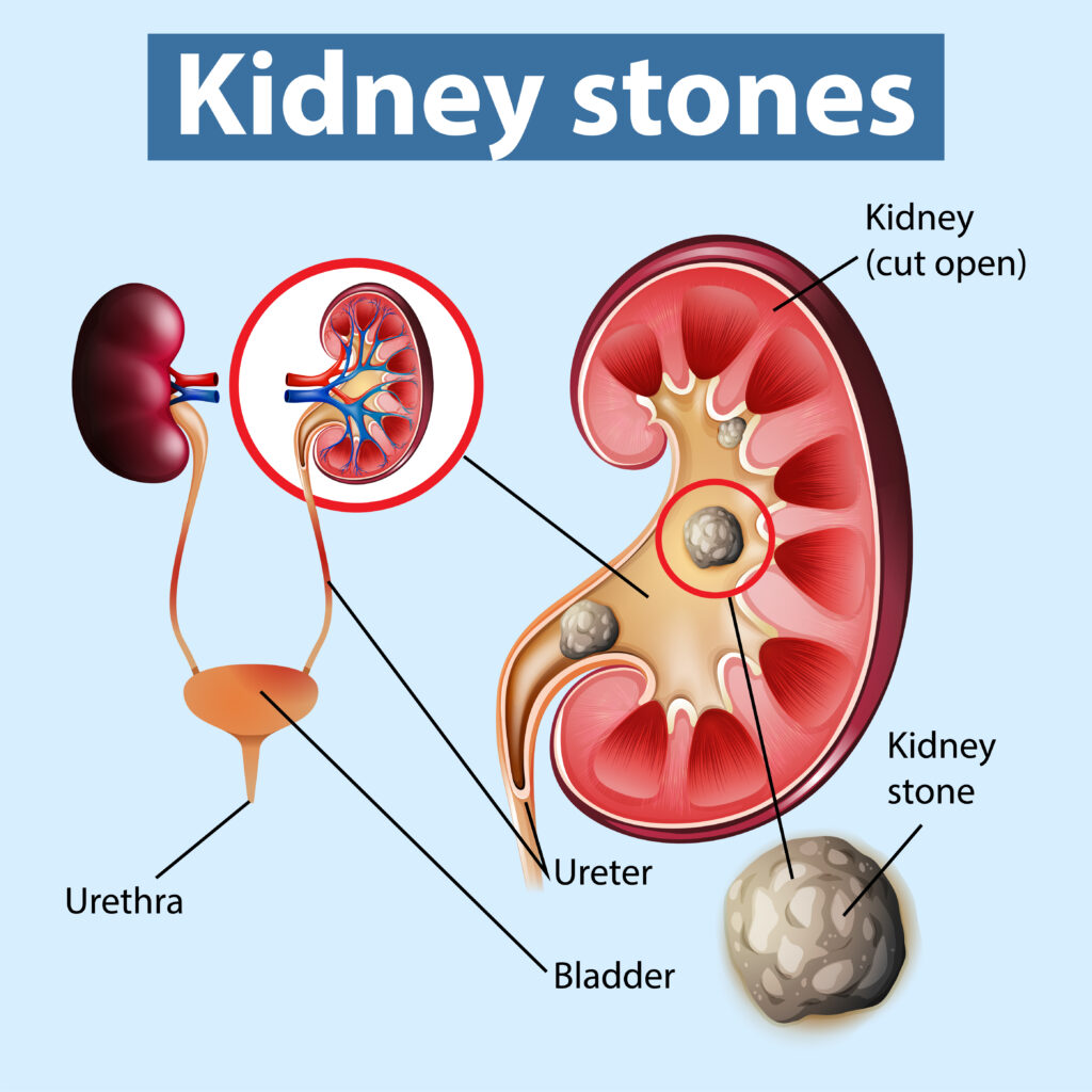 Kidney Stone Treatment in Camp