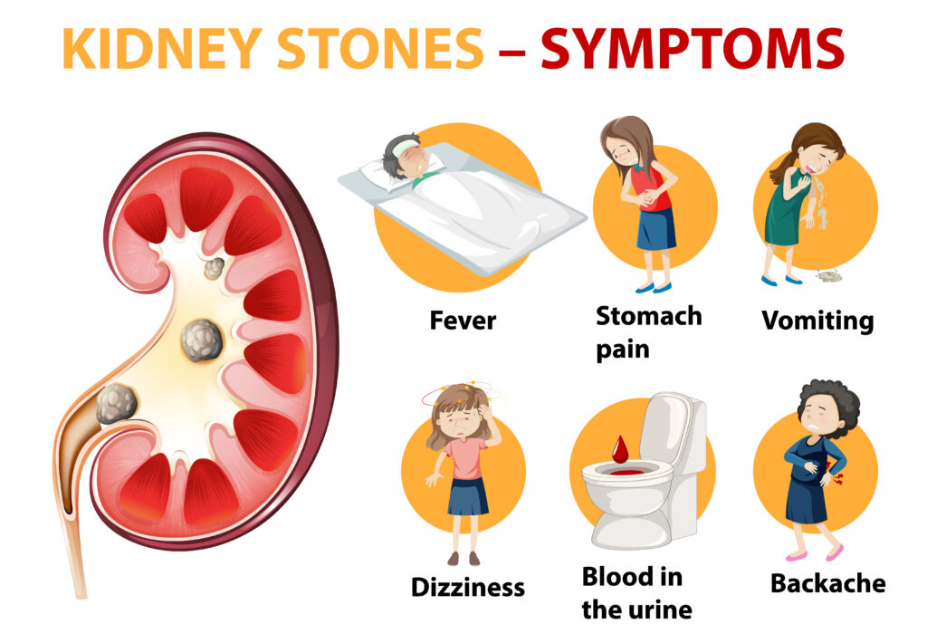 Kidney Stone Treatment in Kondhwa